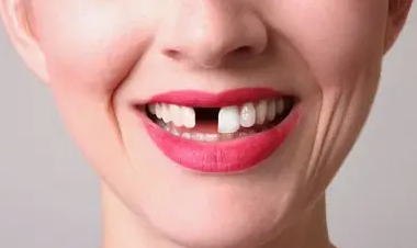 牙齒缺失，應(yīng)該選種植牙還是選烤瓷牙